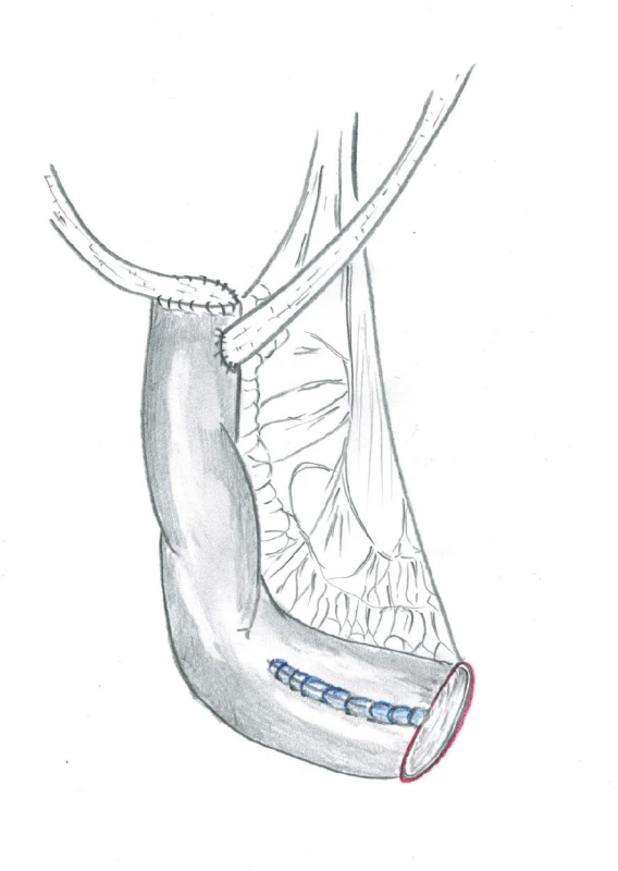 Modrá linie znázorňuje novou suturu (retubularizaci) zbylé části původní neoveziky<br>
Fig. 4. The blue line shows a new suture (retubularization) of the remaining part of the neobladder