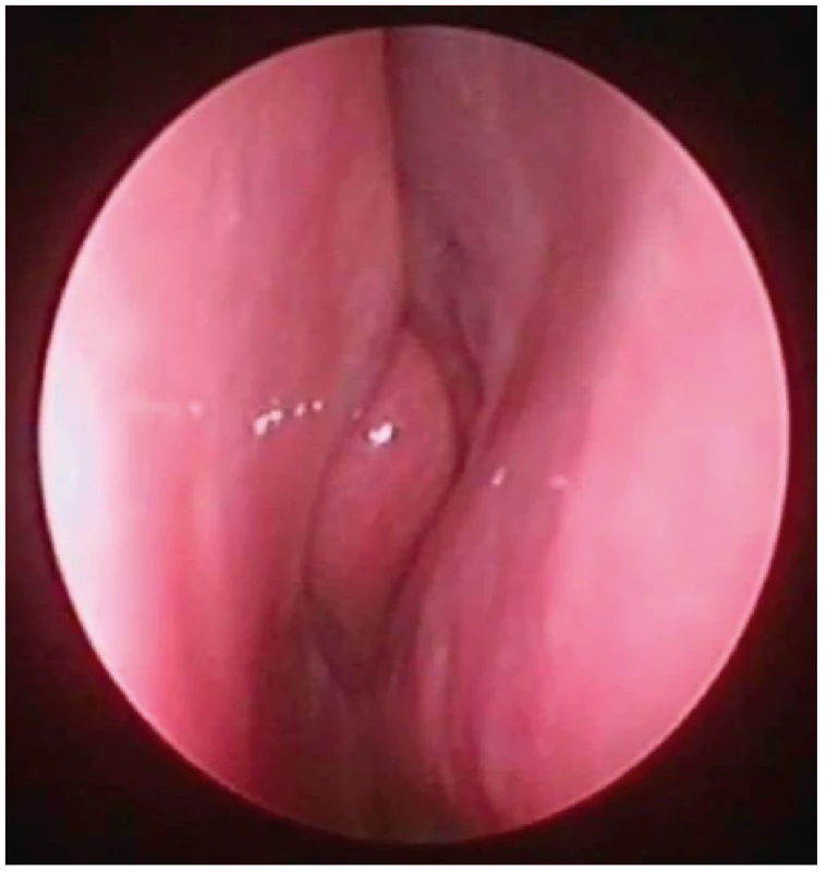 Pohled do nosní dutiny vpravo, endoskopická skupina<br>
III – vybočení septa cca v úrovní střední skořepy (tedy typ 3 dle
Mladiny), bez zjevné hypertrofie dolní skořepy.