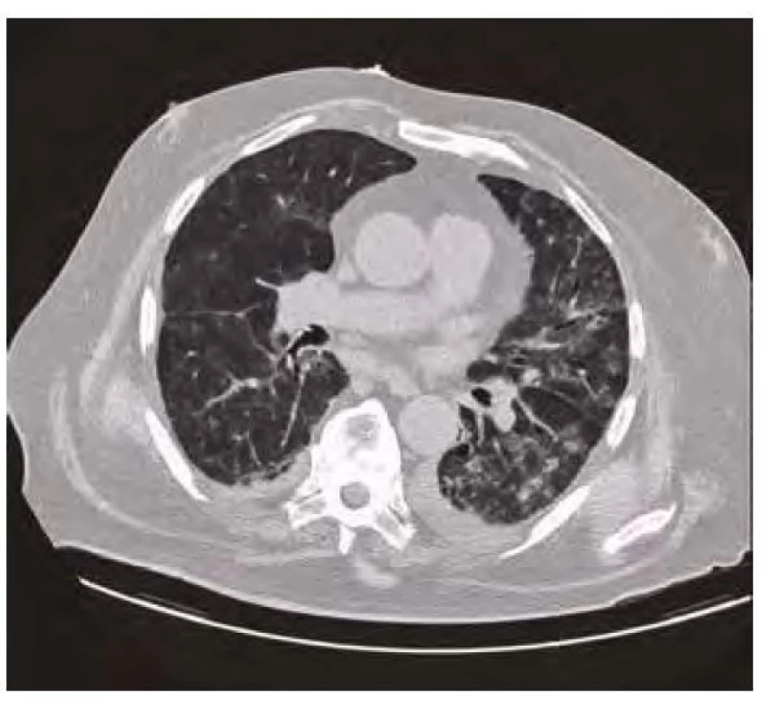 CT plic červenec 2020 – regrese bilaterálních plicních infiltrátů s
reziduálními oboustrannými výpotky