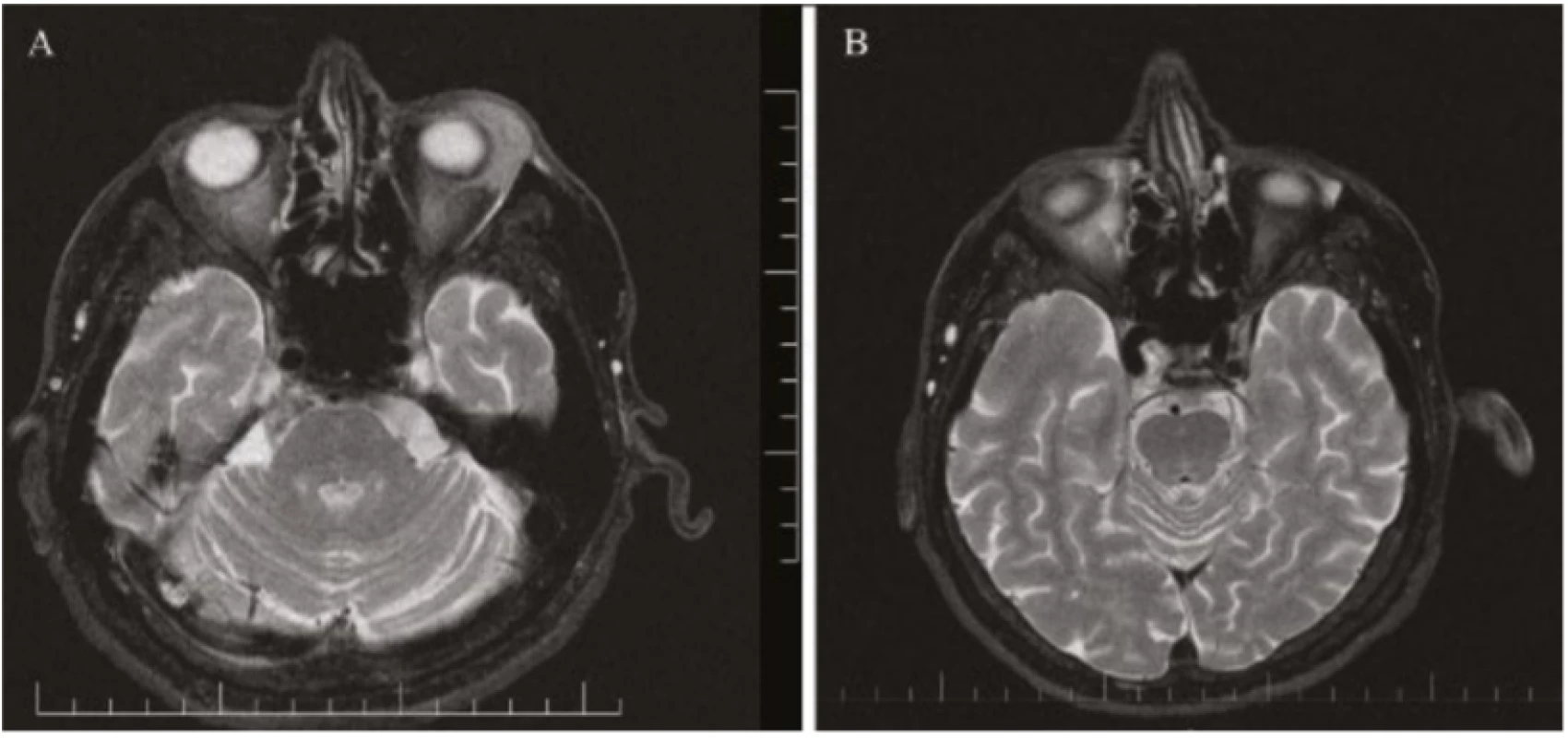 Fig. 5. Patient 2 – magnetic resonance of head: axial cross-section, T2 weighting, lymphoma of lower
left eyelid<br>
A) at time of diagnosis 01/2019<br>
B) following chemotherapy and immunological treatment 11/2019