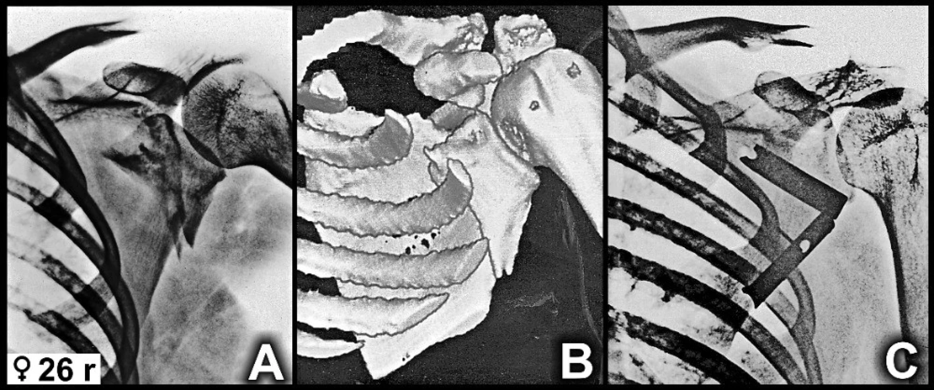  A – preoperative radiograph; B – preoperative 3D CT reconstruction; C – radiograph one year after the surgery