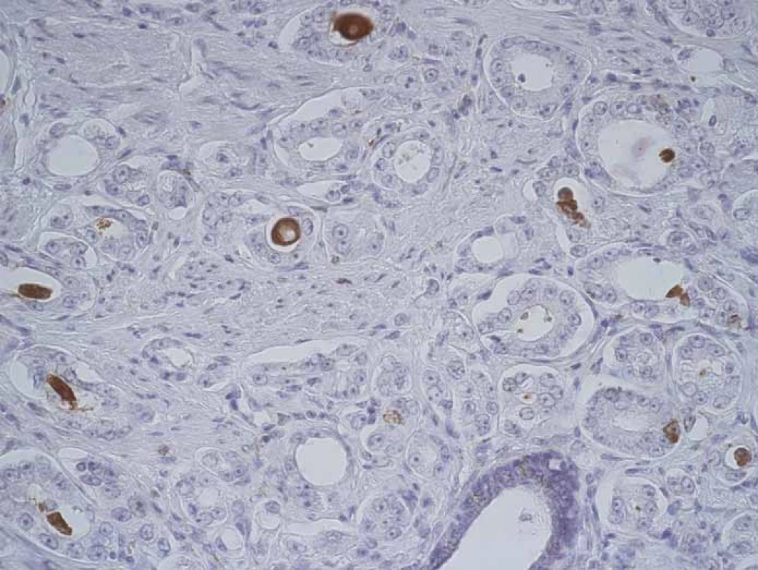 CD204+ macrophages inside prostate cancer structures.
