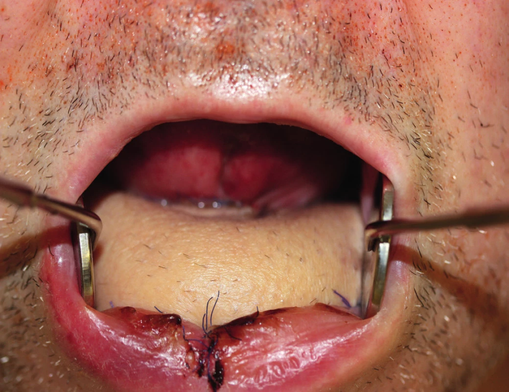 View of the oral cavity after healing of the fibula flap with a skin island (author’s archive)