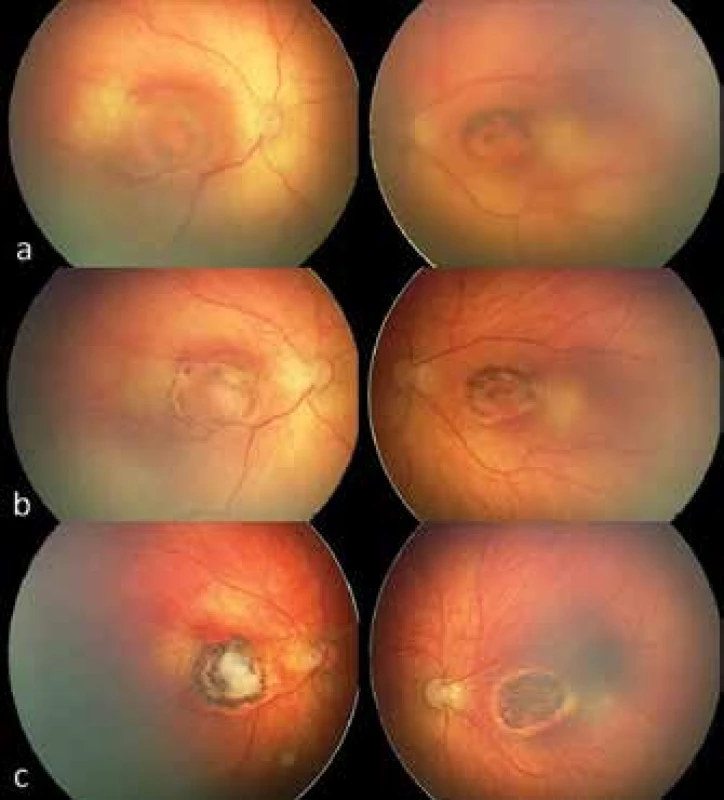 Central toxoplasmic chorioretinitis – retinal finding in boy
with congenital toxoplasmosis infection in both eyes. In the images
two weeks after the birth of the infant (fig. 4a) deposits of active
toxoplasmic chorioretinitis are identified, affecting the region of
the macula. The retinal finding at an interval of 4 weeks after the
commencement of general therapy shows subsiding inflammatory
activity and incipient retinal scarring (fig. 4b) and advanced chorioretinal
deposits of toxoplasmic etiology in the stage of atrophic
scar with pigmented edges, functionally characterised by irreversible
affliction of central visual acuity in the child (fig. 4c). Images
obtained using digital imaging system RetCam, 3rd generation.