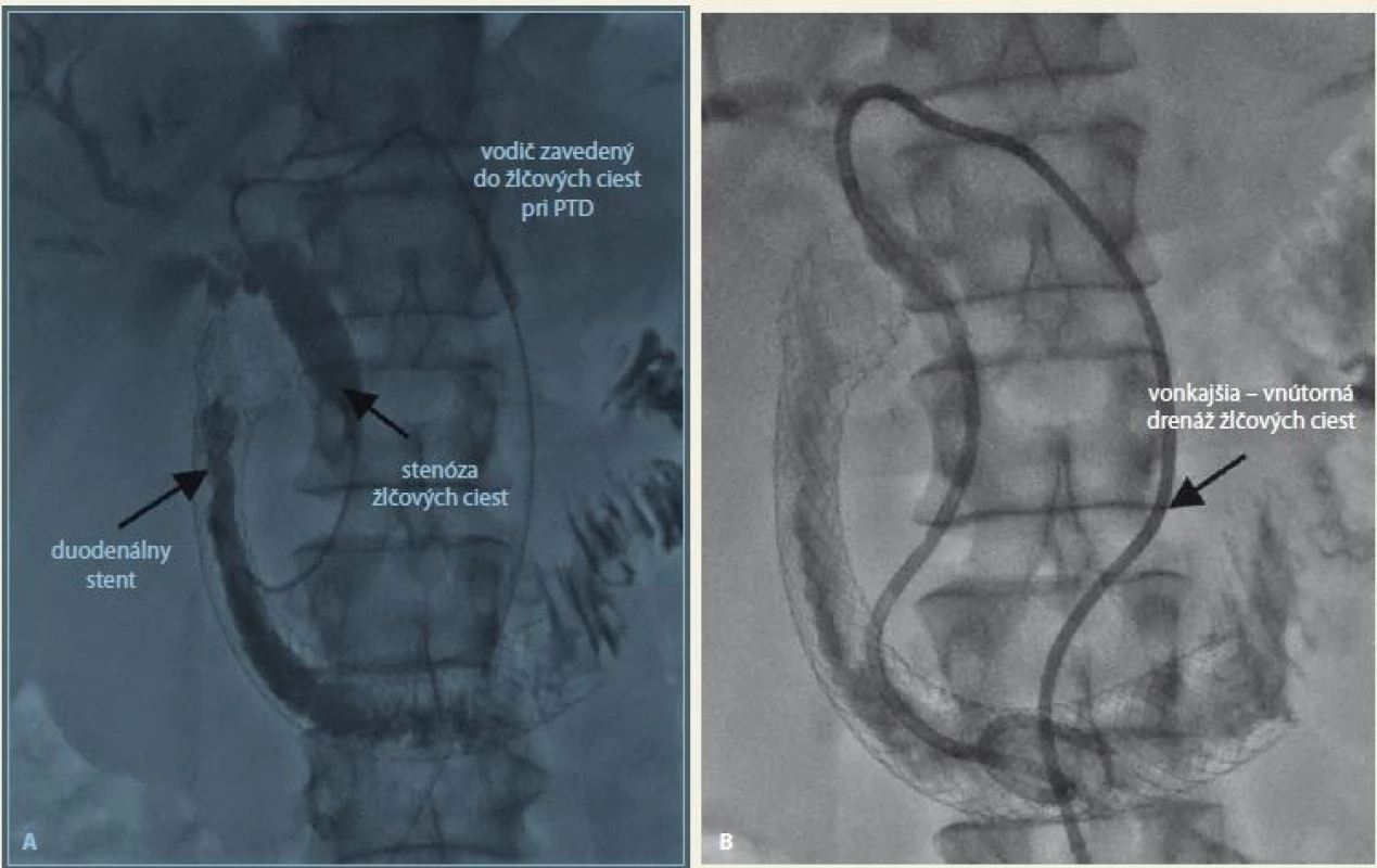 Duodenálný stent s vonkajšou – vnútornou PTD. Zdroj: Archív FN Trnava.<br>
Fig. 4. A duodenal stent with percutaneous transhepatic drainage. Source: Archive FN Trnava.