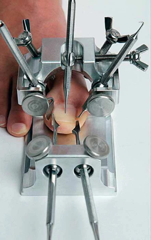 Kostka Arkady – speciální patentovaný nástroj
a instrumentárium k rekonstrukci nehtové ploténky metodou
Arkady