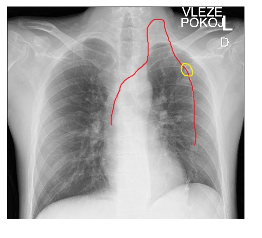 RTG hrudníku u pacienta po alternativní implantaci PICC cestou levé v. jugularis s tunelizací podkožím na hrudník do subklavikulární oblasti, katetr pro zvýšení přehlednosti zvýrazněn červenou barvou, žlutě zvýrazněna pozice výstupu katetru z podkoží a umístění fixačního systému