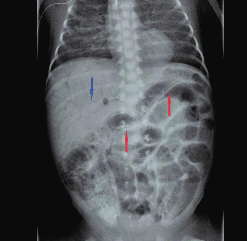 Nativní RTG s nálezem NEC – červené šipky označují
PCI (pneumatosis cystoides intestini), modrá šipka
znázorňuje přítomnost plynu ve větvích v. portae
(PVG).<br>
Fig. 1. Abdominal X-ray in NEC patient. Intramural bowel gas
(PCI) – red arrows; gas in the branches of portal vein
(PVG) – blue arrow.