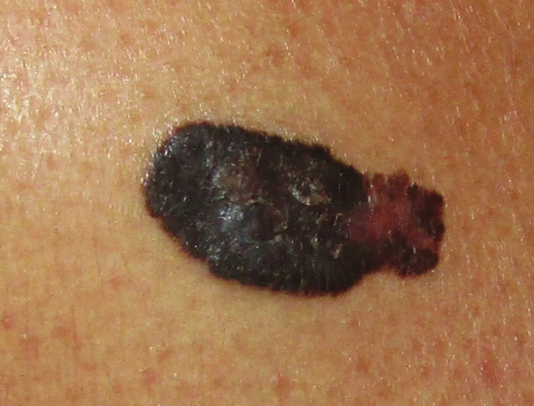 Superficiálně se šířící melanom
