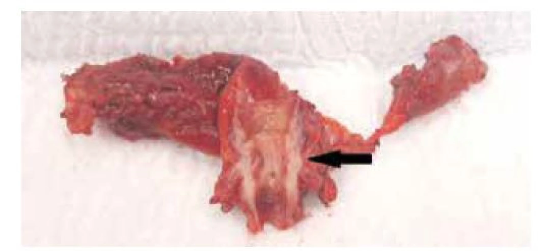 Segmentální resekce žlučových cest, resekát s cholangiokarcinomem
středního žlučovodu (černá šipka)<br>
Fig. 2: Bile duct segmental resection, specimen with middle
bile duct cholangiocarcinoma (black arrow)