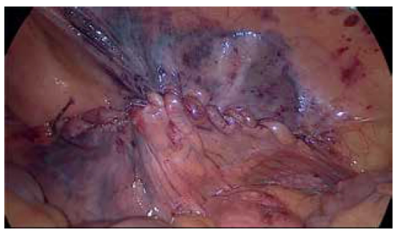 Sutura peritonea<br>
Fig. 4. Closure of the peritoneum