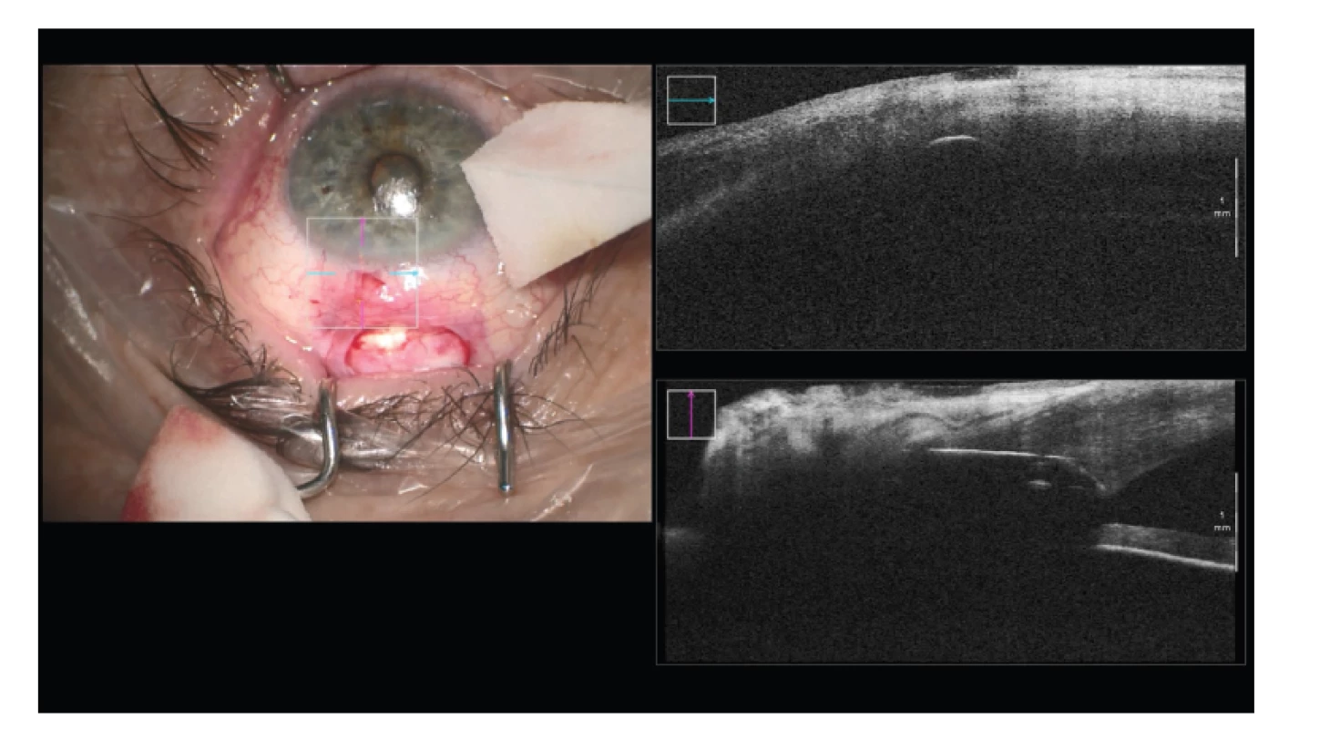 Reimplantace glaukomového implantátu Ex-press – špatná pozice ústí intubace
v rohovkovém stromatu