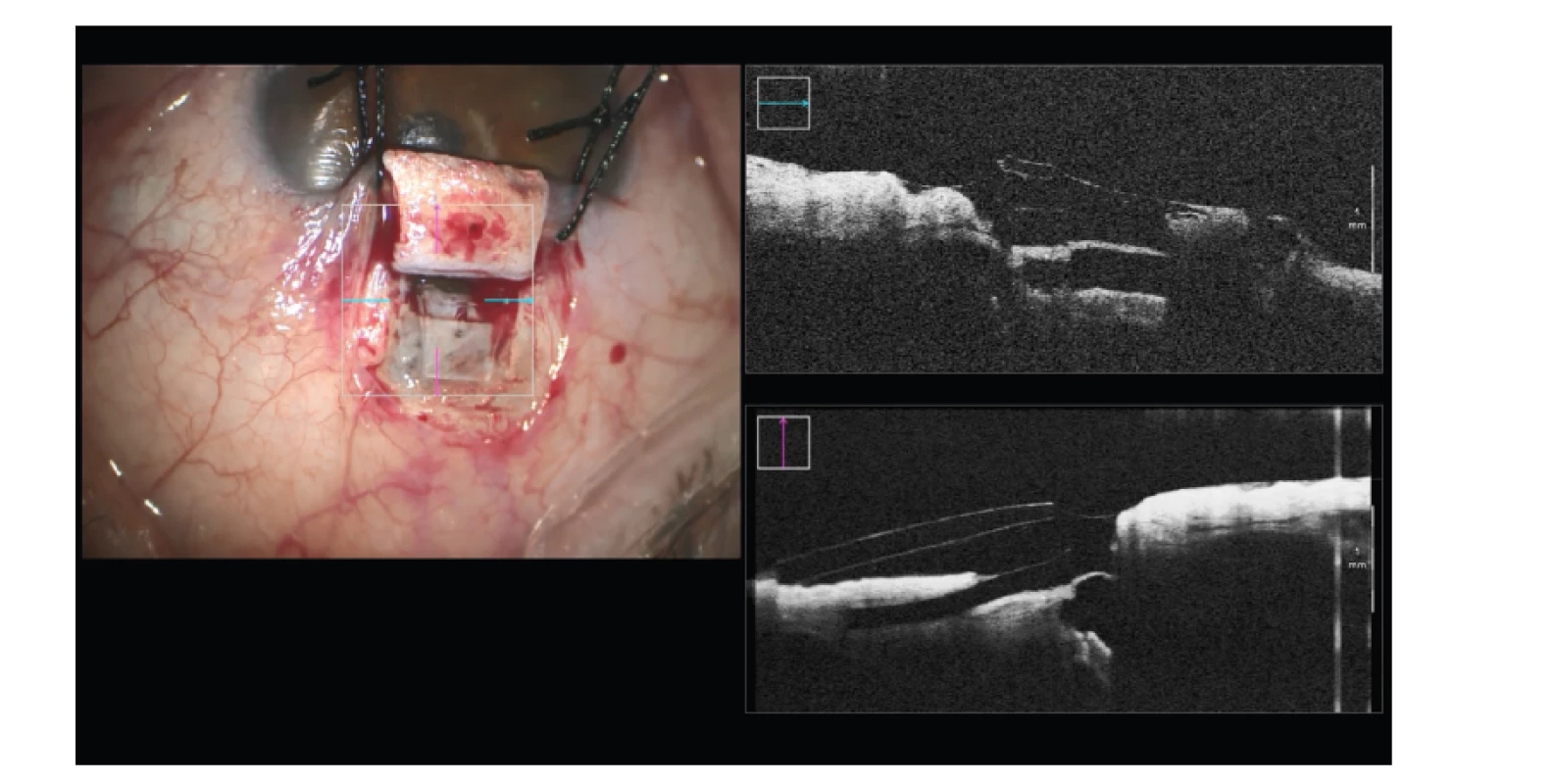 Hluboká sklerektomie s implantací subchoroidálního implantátu Esnoper
Clip – kontrola jeho pozice a celistvosti stěny Schlemmova kanálu