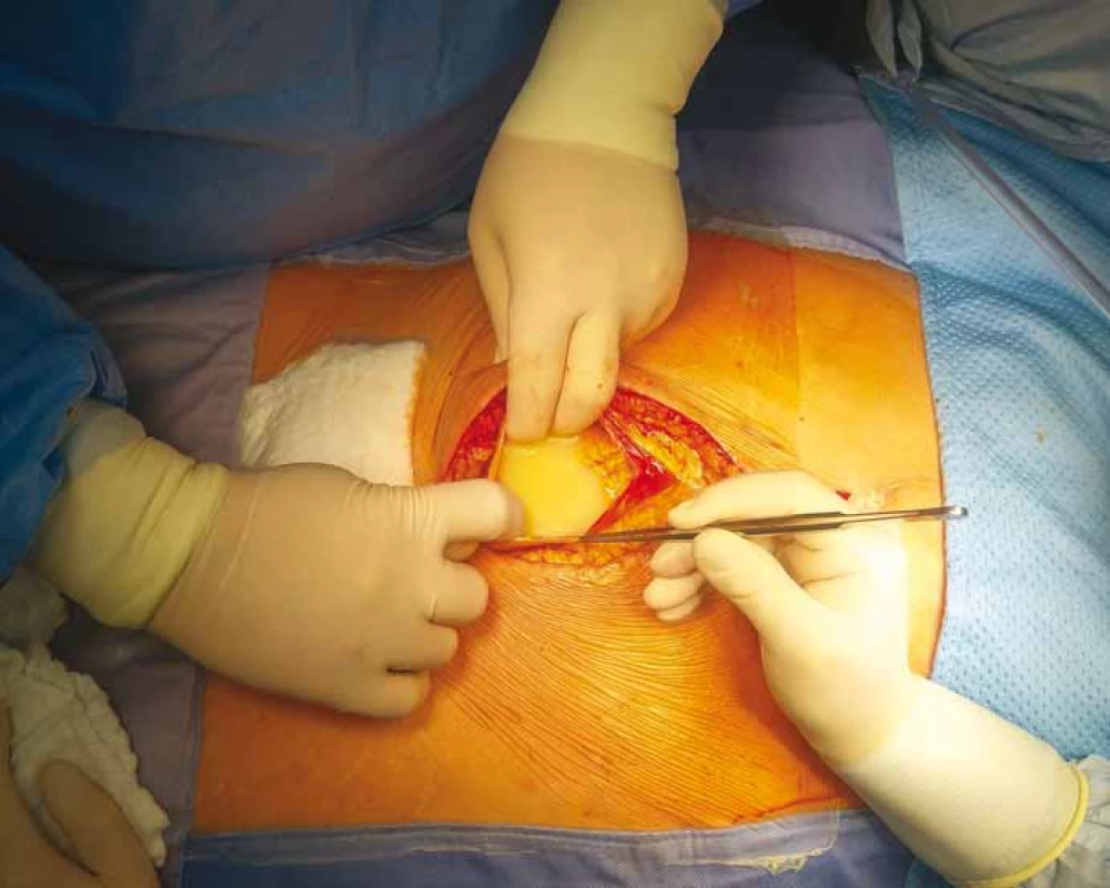 Foto z operace – otevření dutiny břišní a patrná mléčná sekrece, tzv. chylózní ascites
neboli chyloperitoneum.