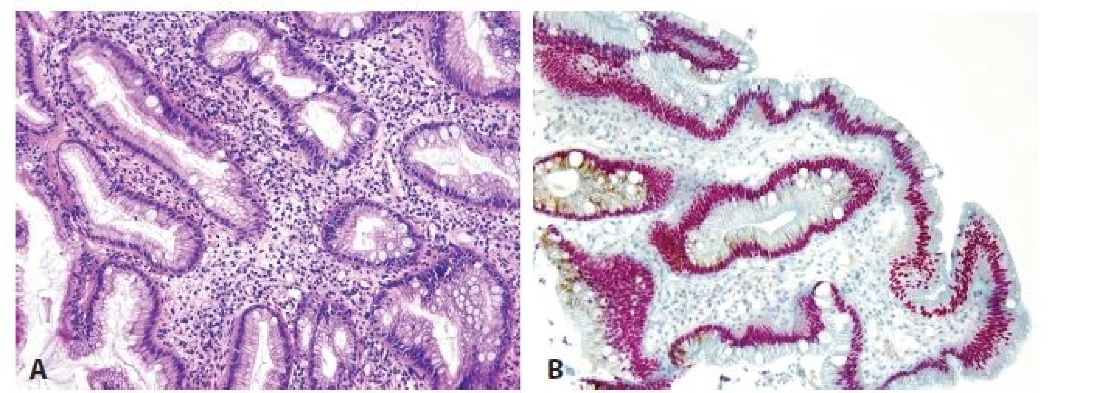 Esophageal incomplete intestinal metaplasia. A. Cylindrical cells with mucin production and without brush border. B. Double
immunohistochemical reaction shows nuclear positivity for CDX2 (red) and cytoplasmic expression for MUC5AC (brown). No
cell with negativity of CDX2 and positivity of MUC5AC is seen (original magnifications 200x).