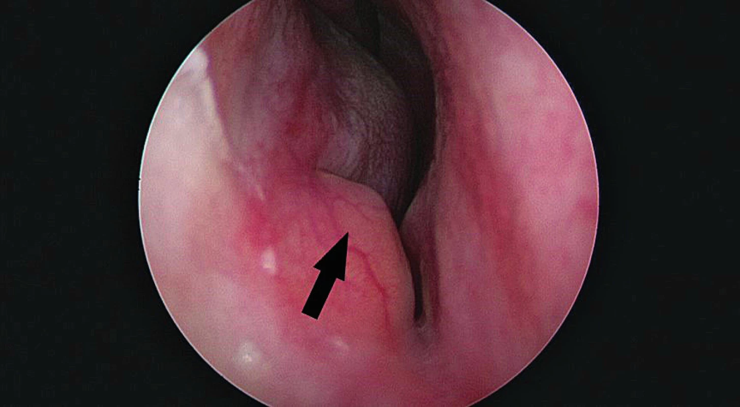 Vyklenutí sliznice v přední části dutiny nosní před
hlavou dolní skořepy (šipka), pravá strana, endoskopický pohled