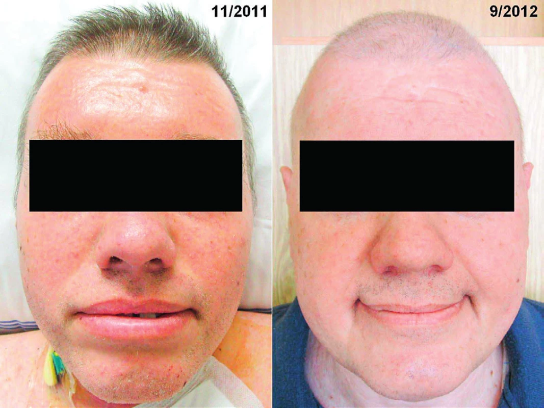 Vlevo: Obličej pacienta se skleredémem: mucinózní infiltrace
kůže a podkoží způsobila zesílení kůže a podkoží a omezení
hybnosti
Vpravo: Obličej pacienta se skleredémem: zlepšení po léčbě
