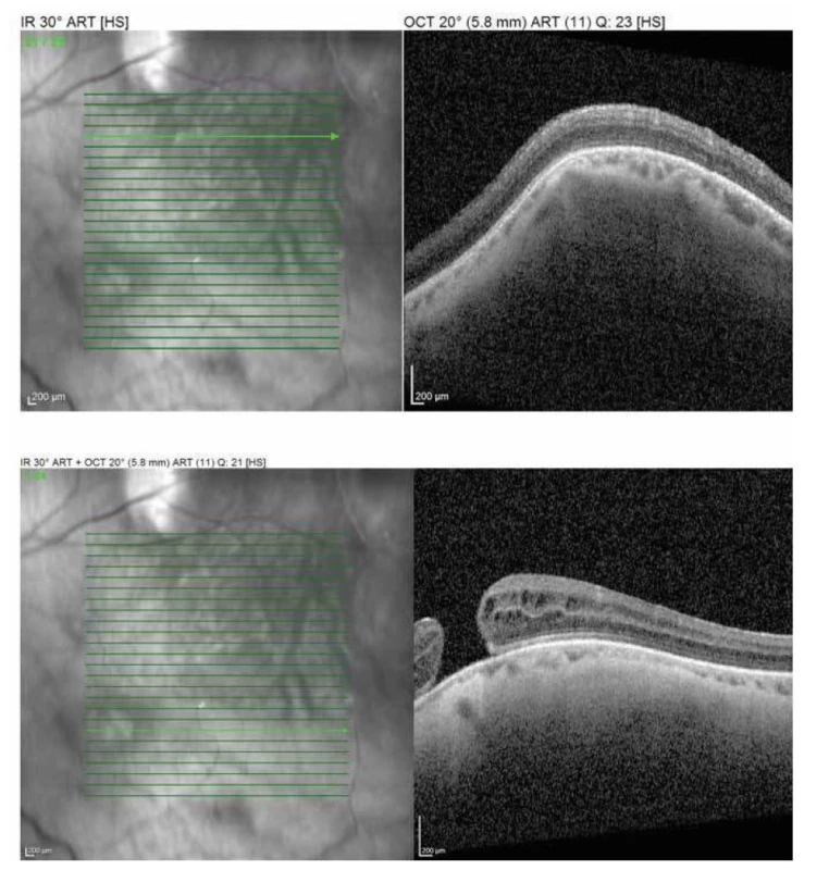 OCT B scan ľavého oka – elevácia choroidey s normálnou hrúbkou sietnice v mieste ložiska
(horná časť scanu), diera makuly (dolná časť scanu)