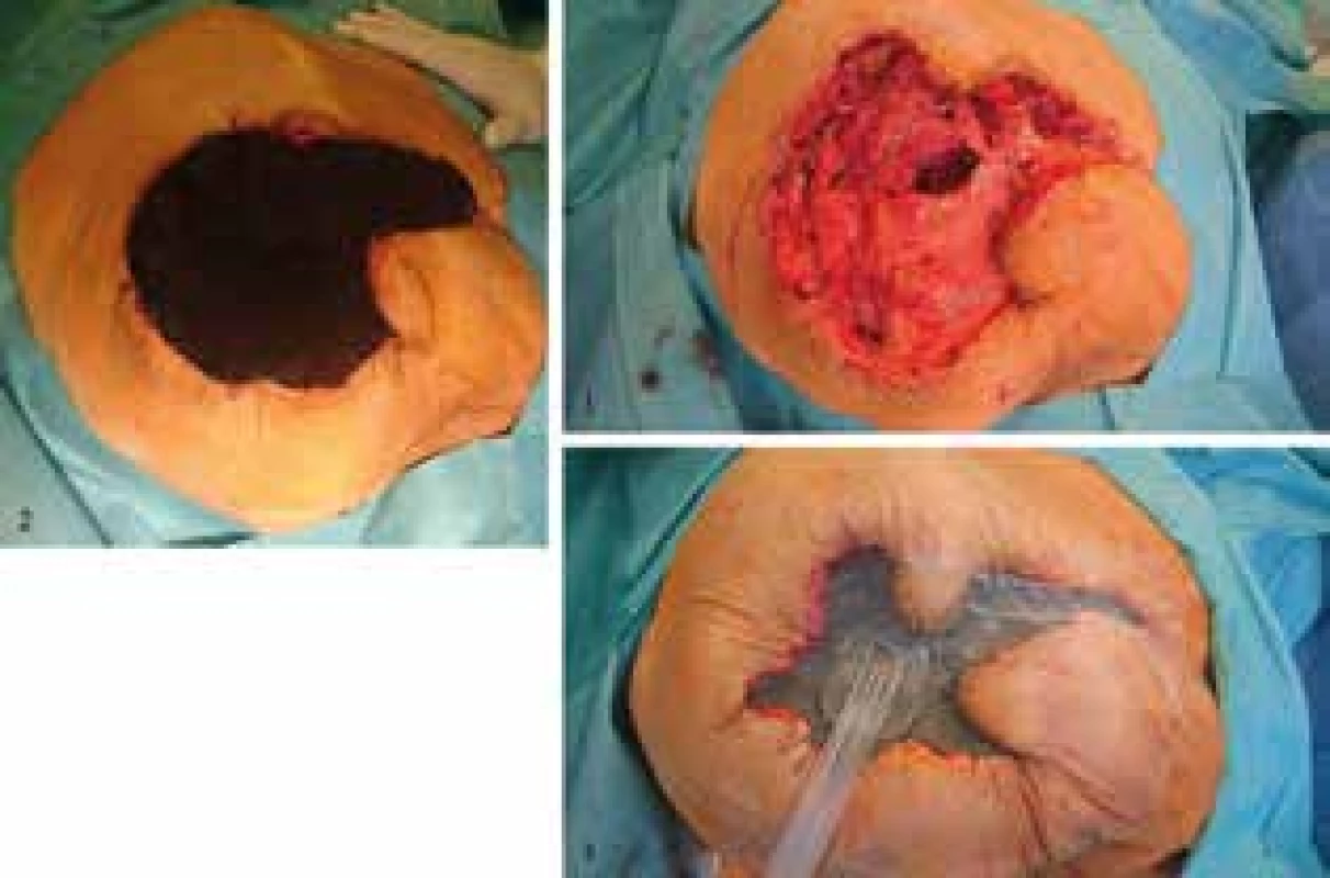 Rána po exartikulaci v kyčelním kloubu, tahové stehy kůže-pěna <br>Fig. 6: Coxal exarticulation wound; skin-foam tension stitches