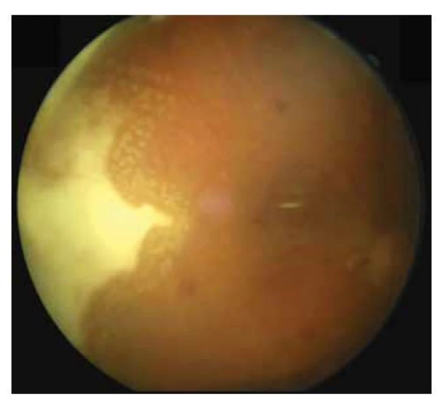 Fotografia očného pozadia pravého oka mesiac po
pars plana vitrektómií