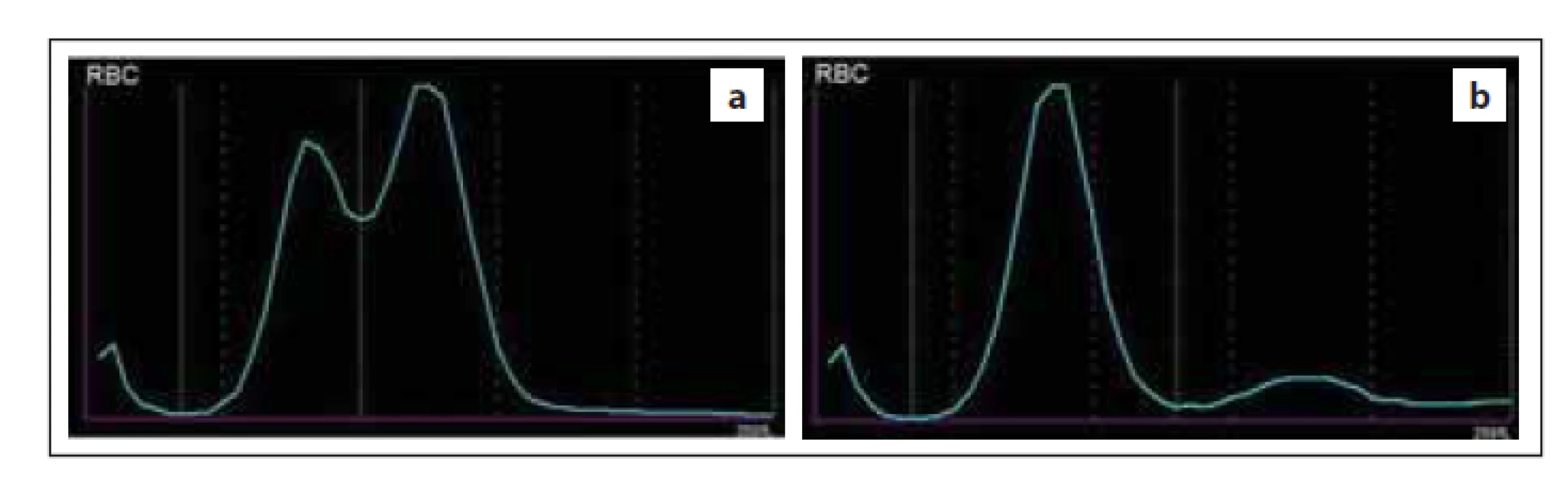 Abnormální průběh distribuční křivky RBC způsobený (a) přítomností
dimorfní populace RBC, (b) aglutinací erytrocytů v přítomnosti chladových
protilátek (zdroj: laboratoř IV. IHK).<br>
RBC – erytrocyty