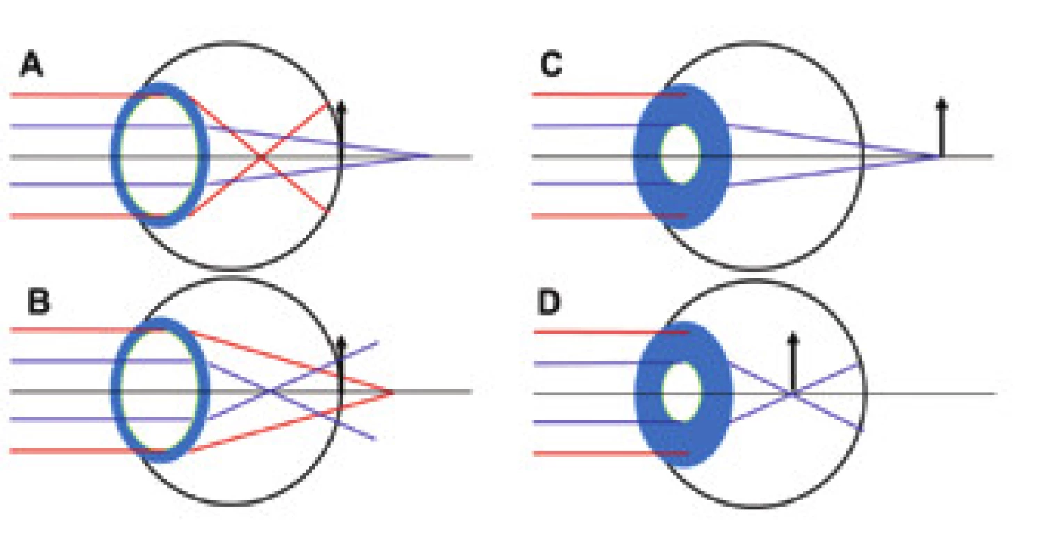 Emetropické oči s 6 mm zornicí a pozitivní (A), negativní (B)
sférickou aberací. Periferní paprsky se více lámou jak paraxiální.
Stejné oči po akomodativní mióze (C a D). Eliminace periferních
paprsků a tím i SA způsobí hypermetropický (C) a myopický (D)
posun. V případě B-D tedy dochází ke zlepšenému vidění na bližší
vzdálenost.