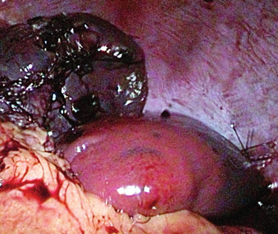 Laparoskopický pohľad na remnant sleziny s dobrou
vitalitou.<br>
Fig. 2. Laparoscopic view of the remnant of the spleen with
good vitality.