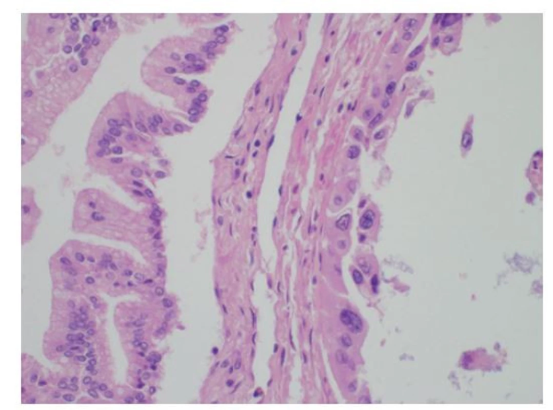 Histologie lehké dysplazie žlučovodu BiIN1b
s papilárně utvářeným vysokým mucinózním cylindrickým
epitelem s bazálně uloženými jádry (vlevo) a těžké
dysplazie BiIN3 s nápadnými jadernými atypiemi a ztrátou
polarity epitelu (vpravo), HE, 400×<br>
Fig. 10: Histology of a low-grade bile duct dysplasia
BiIN1b with polarized papillary tall columnar mucin-producing
epithelium (on the left); high-grade dysplasia
BiIN3 with marked cytonuclear atypia and loss of epithelium
polarity (on the right); HE, 400×