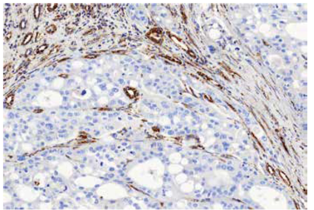 Immunohistochemical staining for FH – detail. 200x