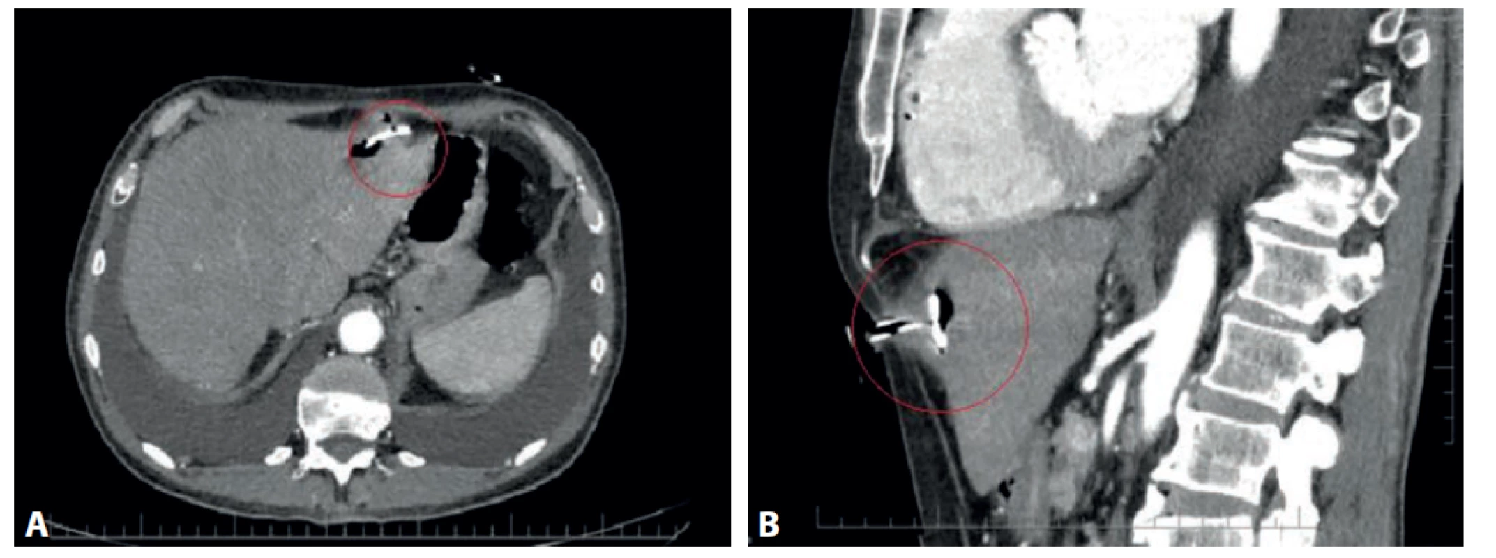 CT vyšetrenie s nálezom dislokovaného PEG a hepatálnym abscesom (červený krúžok):<br>
a) axiálna projekcia, b) sagitálna projekcia<br>
Fig. 1. CT scan with PEG dislocation and hepatic abscess (red circle):<br>
a) axial projection, b) sagittal projection