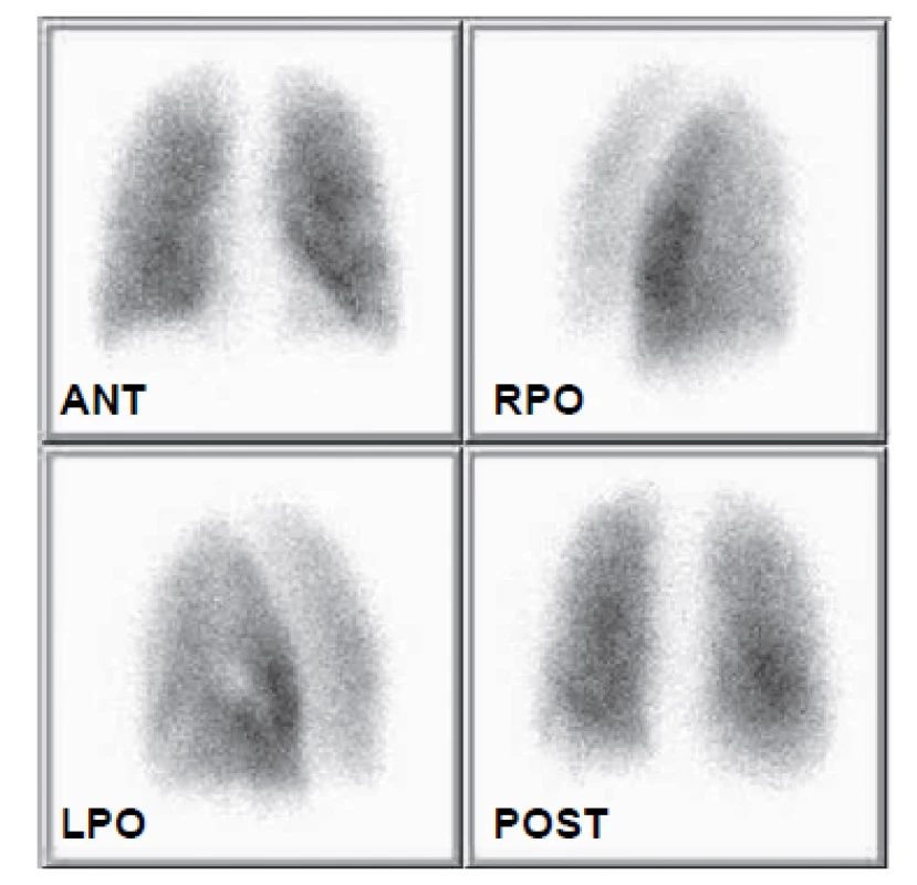 Kontrolní scintigrafie plicní perfuze 31. 3. 2008. Perfuze obou
plic je prakticky homogenní, během dvou týdnů došlo k téměř kompletní
rekanalizaci embolů.
