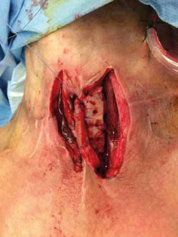 Parastomálna implantácia rebrových chrupiek <br>Fig. 5: Parastomal implantation of the costal cartilages