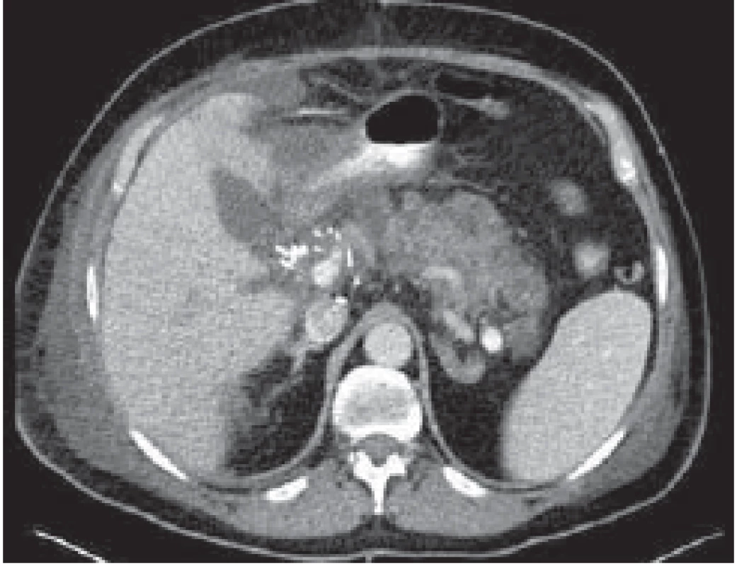 CT obraz nekrotizující
akutní pankreatitidy u pacienta po
transplantaci jater.<br>
CT image of necrotizing acute
pancreatitis in a patient after liver
transplantation.