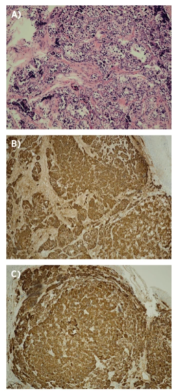 Neuroendokrinný karcinóm - histopatologický obraz,
kazuistika 2.<br>
A – heatoxylín-eozín, B – chromogranín, C- synaptofyzín