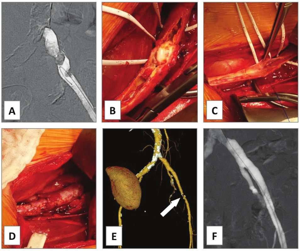 Endarterectomy of external iliac artery, case 3