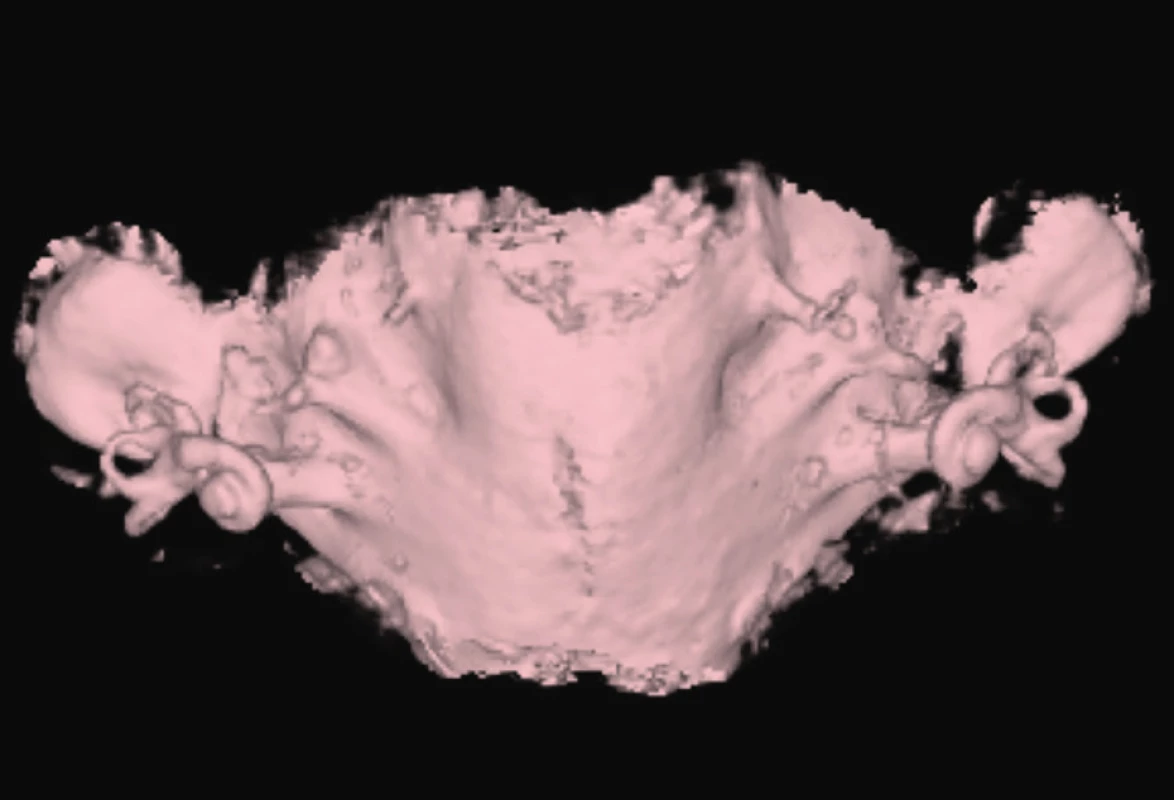 EVA syndrom, syndrom rozšířeného vestibulárního
akvaduktu.<br>
Fig. 6. Enlarget vestibular aquaeduct.