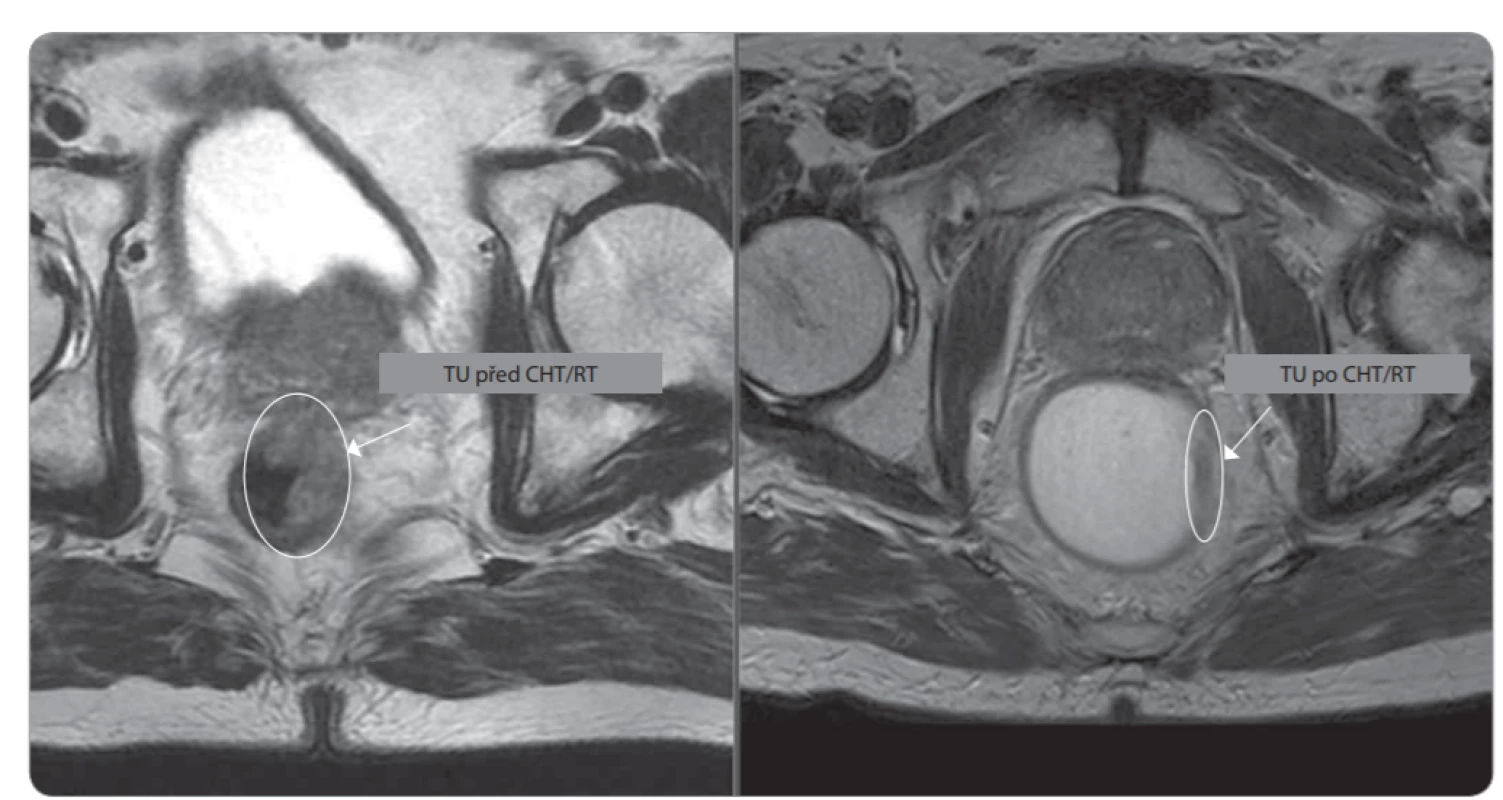 Detekce nádoru na T2 axiálním řezu před neoadjuvatní CHT/RT (vlevo) a následně po ní (vpravo).
CHT – chemoterapie, RT – radioterapie