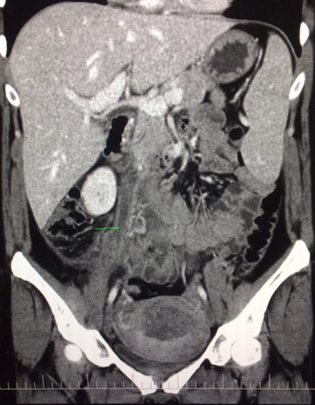 CECT 8th postpartum day: right ovarian vein thrombosis
(green mark), congestive enlarged right adnexa, hepatomegaly
and splenomegaly