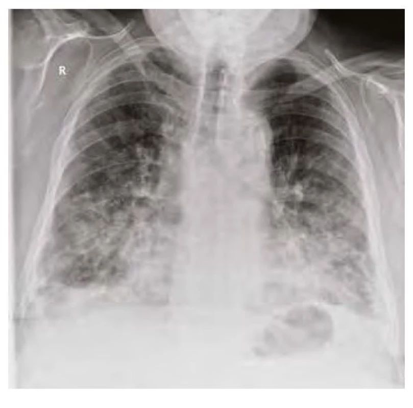 RTG plic z dubna 2020 vstupní – bilaterální zastínění s maximem
v dolních a středních plicních polích