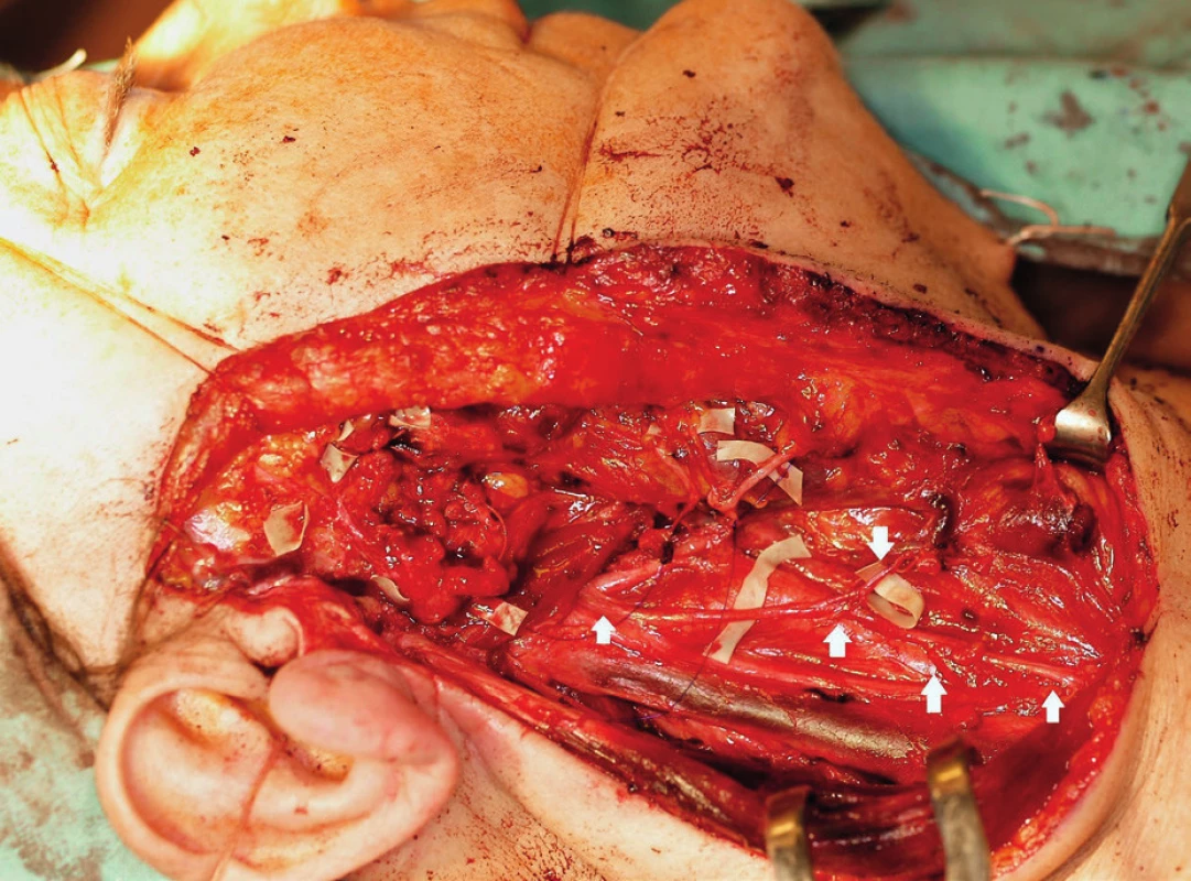 Intraoperative photo. Situation after the radical parotidectomy,
modified subradical neck dissection and preparation of
ansa cervicalis and its branches.
