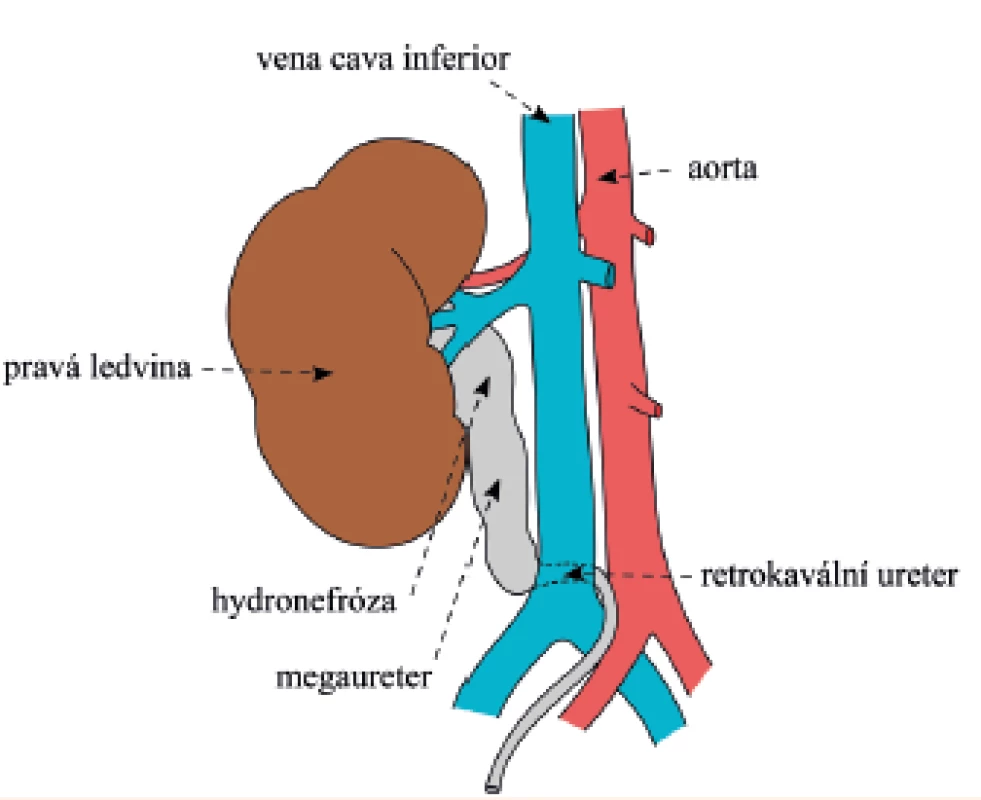 Schematické zobrazení retrokaválního ureteru ve vztahu k velkým cévám (převzato a volně upraveno podle [8]).