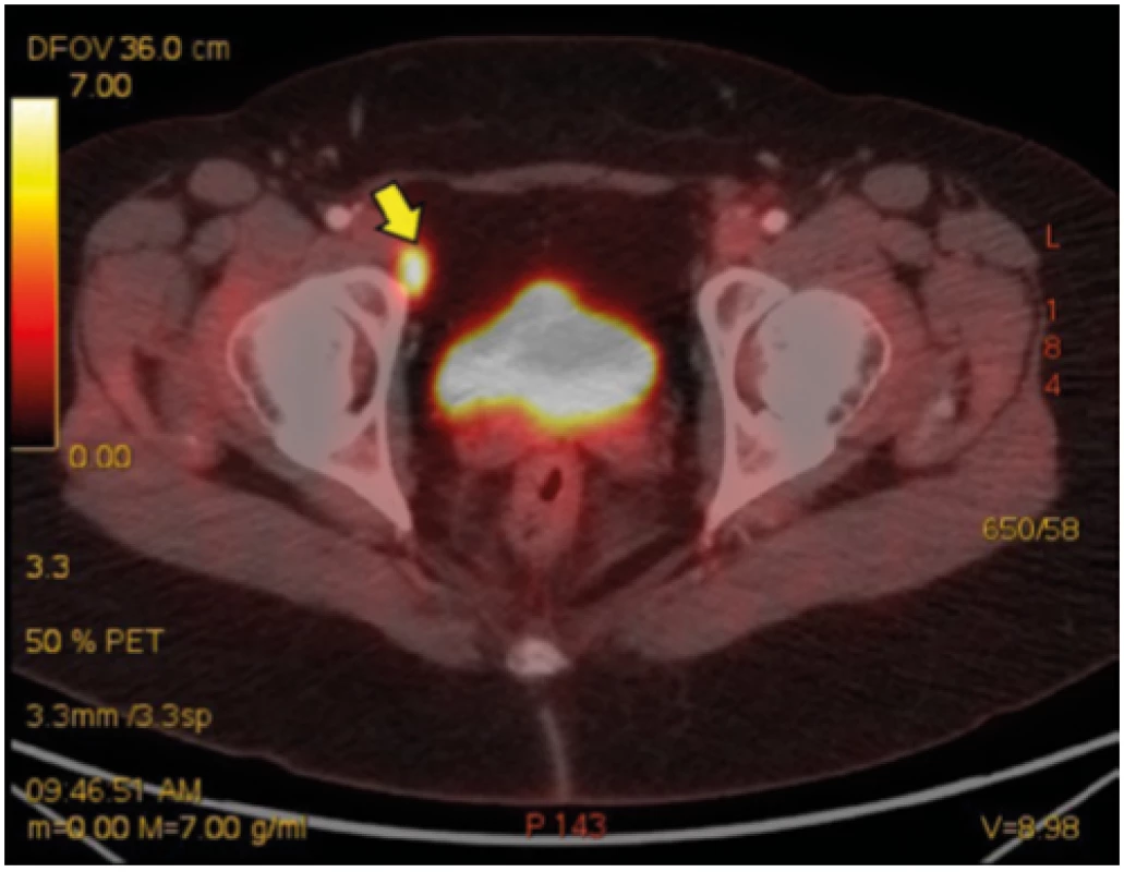 Radiologický obraz onemocnění – kazuistika 2