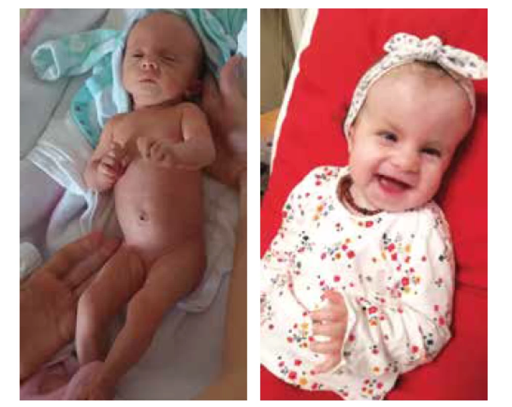Edwardsův syndrom, postnatální fenotyp:<br>
a) po porodu,<br>
b) věk 18 měsíců.<br>
Fig. 2. Edwards syndrome, postnatal phenotype:<br>
a) after delivery,<br>
b) age 18 months.