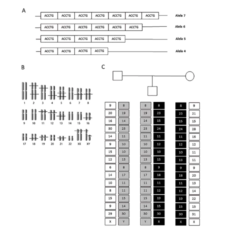 Základní principy STR analýzy. (A) Příklad struktury polymorfního STR lokusu, alely jsou označovány počtem repetic,
které obsahují. (B) Rozložení polymorfních STR lokusů na chromozomech na příkladu panelu obsaženém v hojně využívaném
kitu AmpF/STR Identifiler. (C) Kompletní STR profily tria otec-dítě-matka s vyznačením maternálního (černě) a paternálního
(šedě) profilu, tyto profily spolu s frekvencemi jednotlivých alel slouží k výpočtu paternitního indexu.<br>
Fig. 1. Basic principles of STR analysis. (A) Example of the structure of a polymorphic STR locus, alleles are indicated by the
number of repeats they contain. (B) Distribution of polymorphic STR loci on chromosomes on the example of a panel included
in a widely used kit AmpF/STR Identifiler. (C) Complete STR profiles of the father-child-mother trio with maternal (black) and
paternal (gray) profile, these profiles together with the frequencies of individual alleles are used to calculate the paternity index.