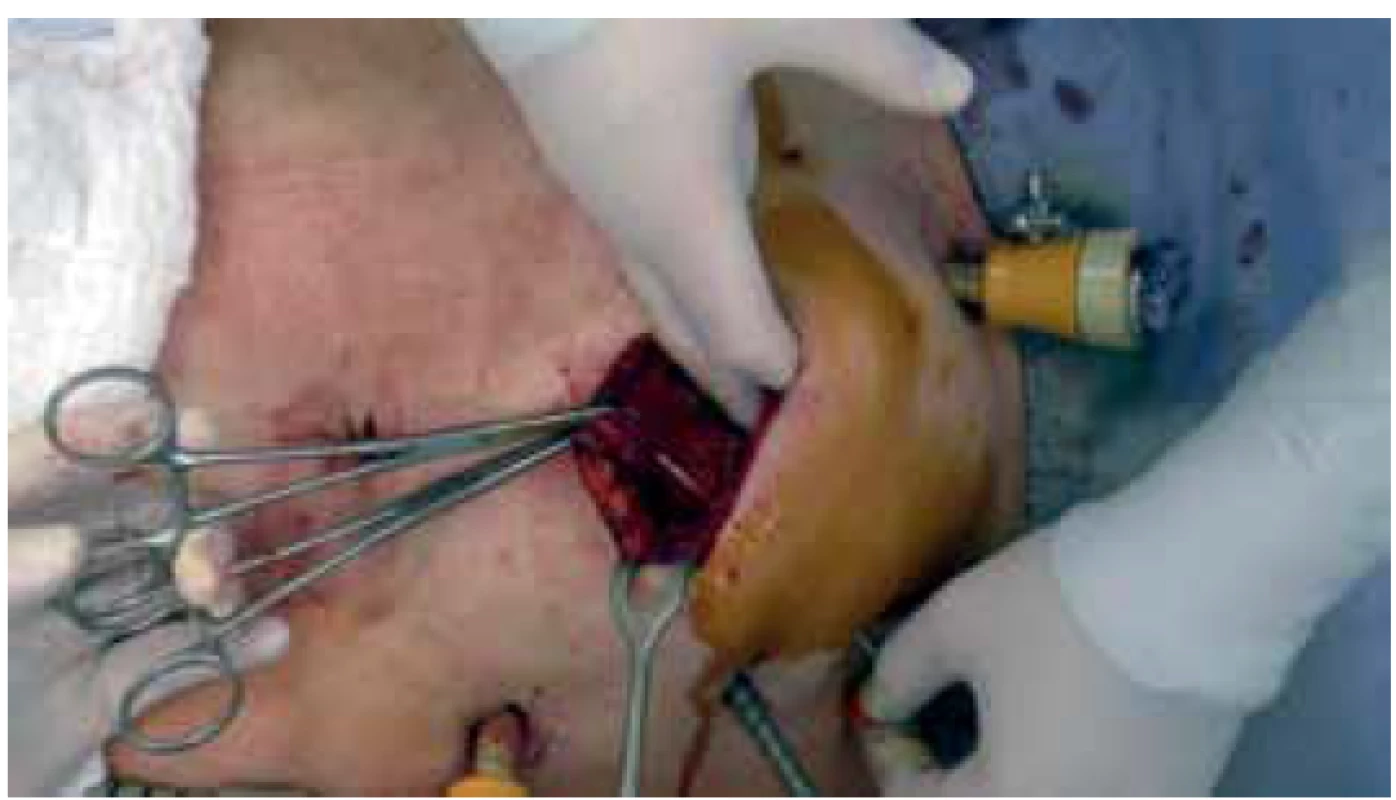 Zavaděč katétru v laparotomii<br>
Fig. 1. Catheter introducer in laparotomy