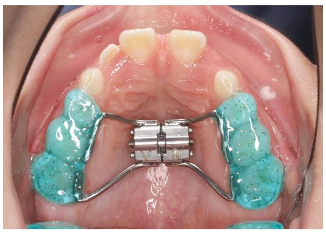 Pryskyřičný aparát se
šroubem (zdroj: archiv
ortodontického oddělení FN
Motol)<br>
Fig. 1 Resin apparatus with a screw
(source: archive of the
orthodontic department of the
Motol University Hospital)