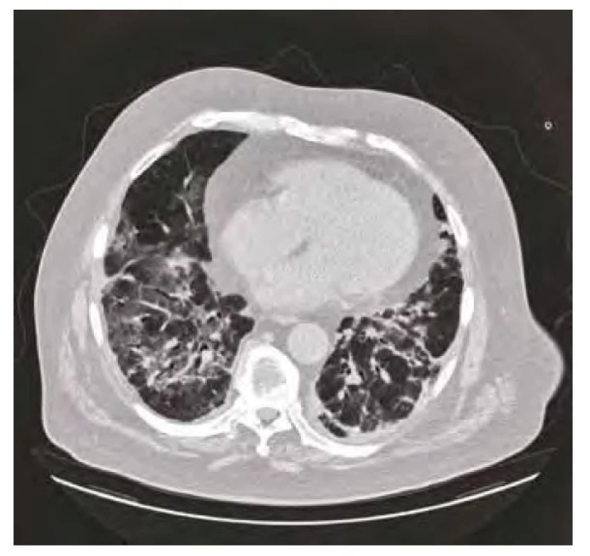 CT plic duben 2020 – bilaterální postižení plicního parenchymu
typu ground-glass s okrsky drobných konsolidací
