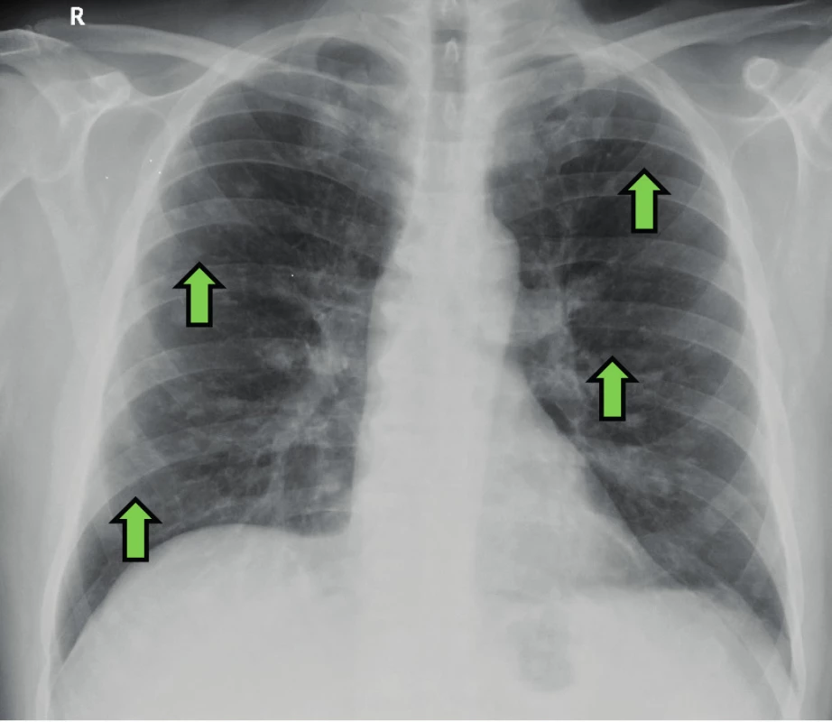 Zadopřední snímek hrudníku pacienta s IgG4 asociovaným onemocněním a plicním postižením. Nodulární zastínění oboustranně difuzně
(zelená šipka).
