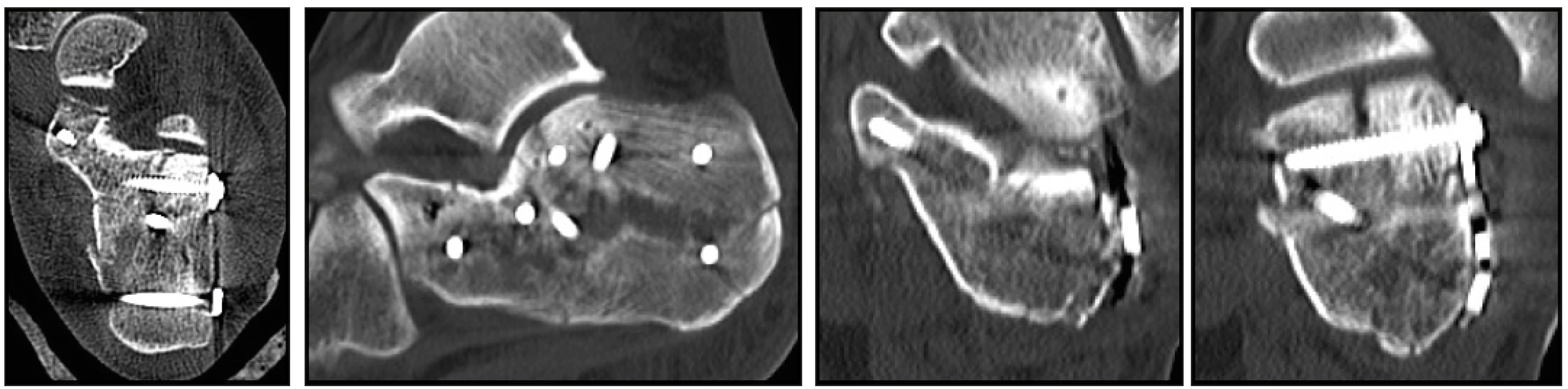 Pooperační CT obrazy po osteosyntéze zlomeniny patní kosti dlahovou osteosyntézou
