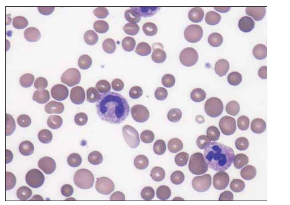 Dárcovské normocyty a makrocyty v nátěru periferní krve u nemocné
s megaloblastovou anémií (zdroj: laboratoř IV. IHK).
